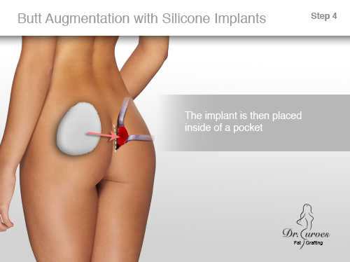 Silicone Butt Implant 51