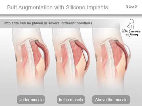 Silicone Butt Implants 37