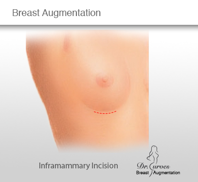 Breast Augmentation Inframammary Incision