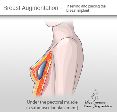 Breast Augmentation Inserting and placing the breast implant