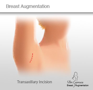 Breast Augmentation Transaxillary Incision