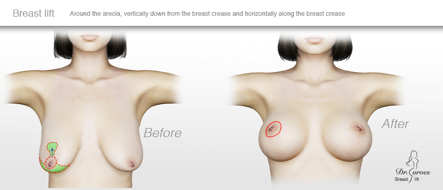 Breast lift 3