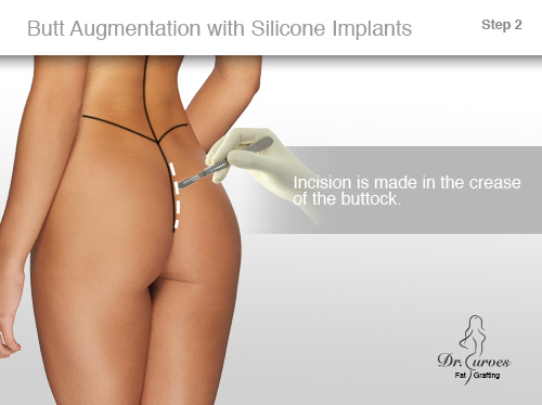 Butt Augmentation with Silicone Implants 1-2