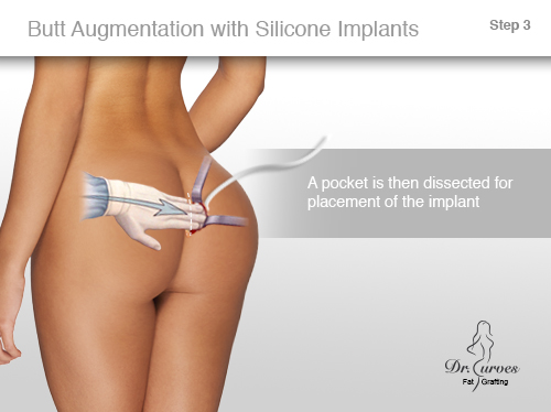 Butt Augmentation with Silicone Implants 3