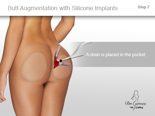 Butt Augmentation with Silicone Implants 7