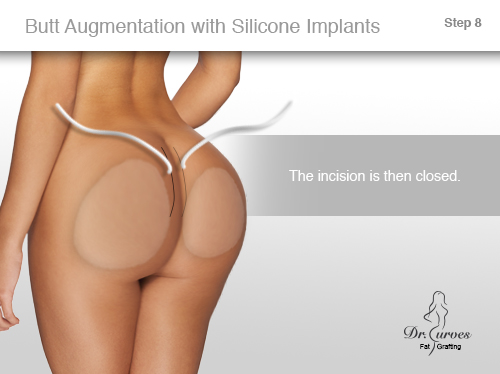 Butt Augmentation with Silicone Implants 8