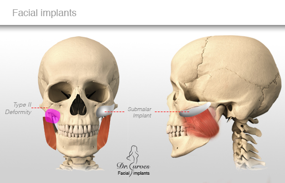 Facial implants 1