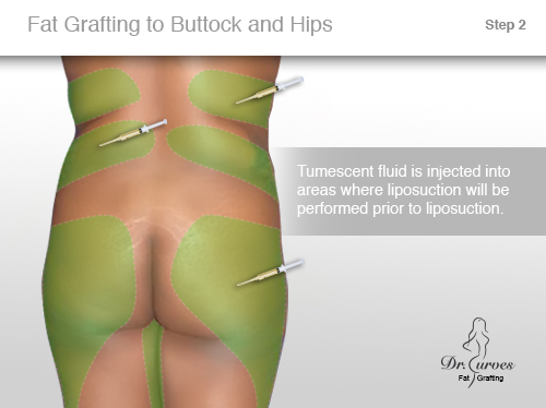 Fat Grafting to Buttock and Hips 2