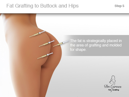 Fat Grafting to Buttock and Hips 5