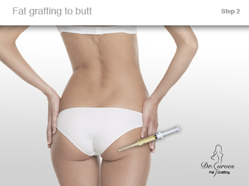 Fat grafting to butt 2