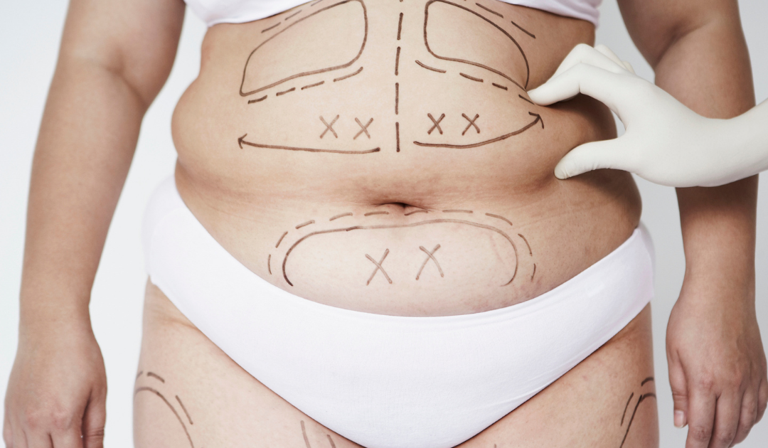 Why Some Liposuction Results Look Smooth — And Others Don’t