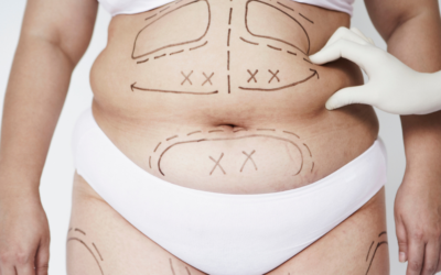 Why Some Liposuction Results Look Smooth — And Others Don’t